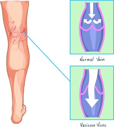 Normal versus varicose veins illustration.